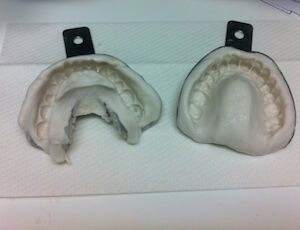 Braces Molds Molds Of Teeth For Braces
