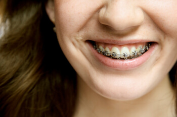 metal-braces-closeup.jpg
