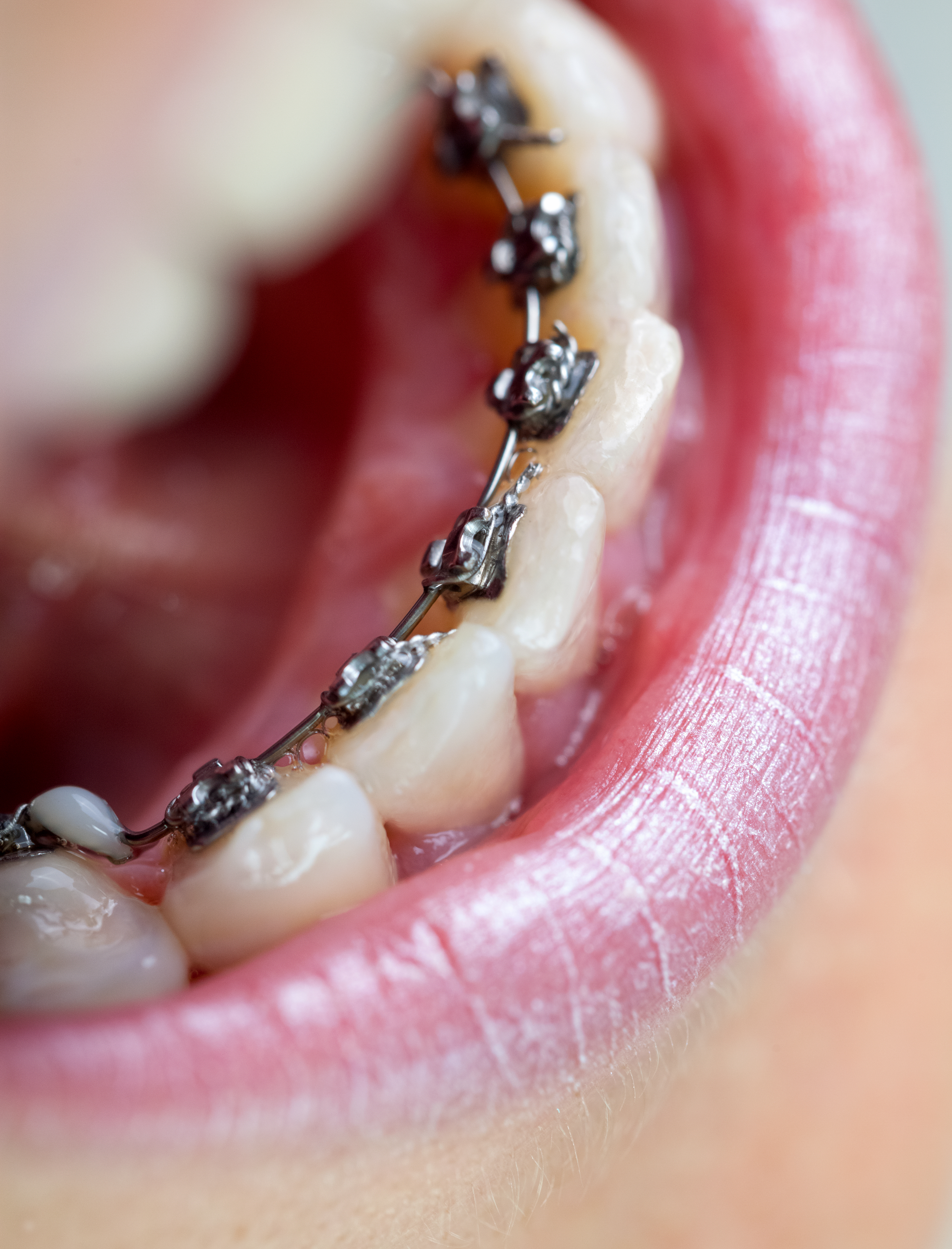 Lingual Braces