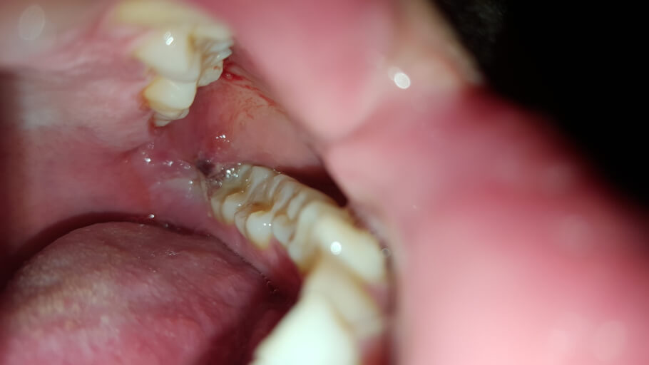 wisdom teeth healing process pictures