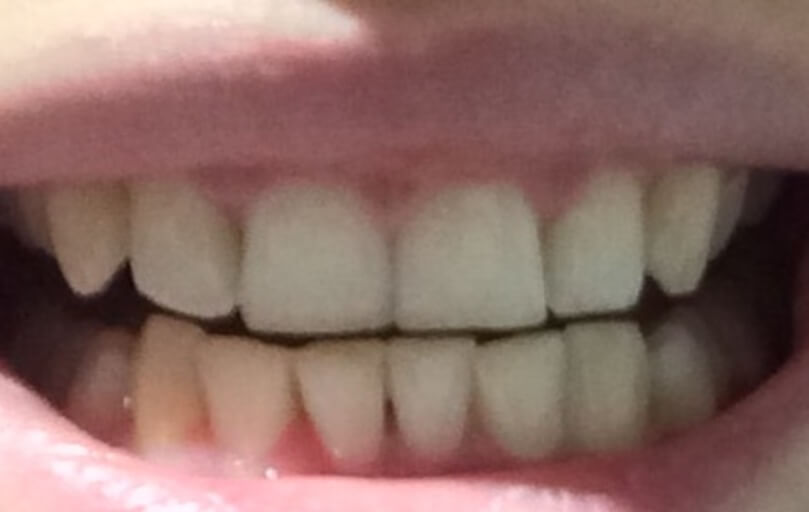 teeth gap bottom