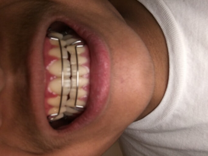 What If I Don't Wear a Retainer After Braces Come Off? - Medland