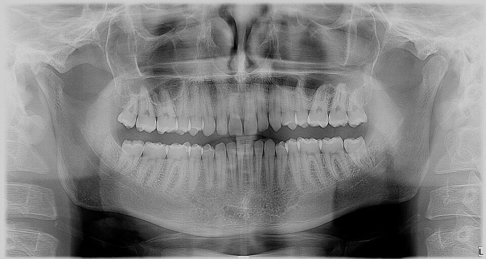 Jaw Xrays