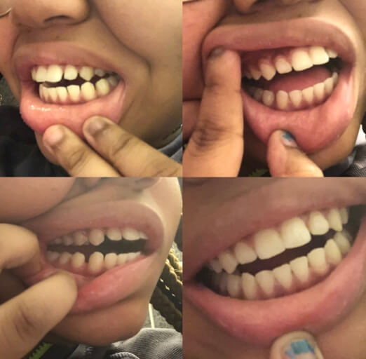 How To Know If We Need Braces Do You Need Braces 4 Ways You Can Tell Team Cos Find All