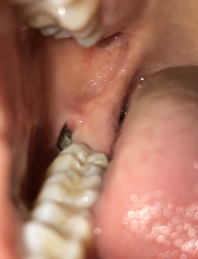 What is this grey stuff in my wisdom tooth extraction site