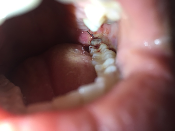 wisdom teeth infection before removal