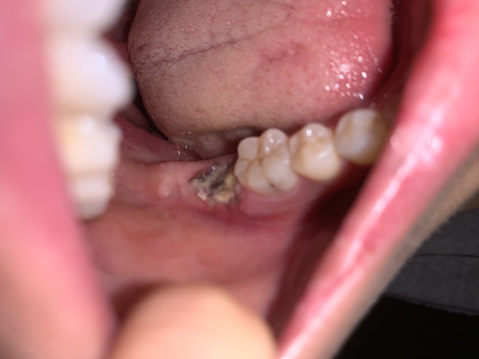 normal healing after tooth extraction
