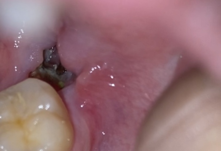 wisdom tooth extraction hole