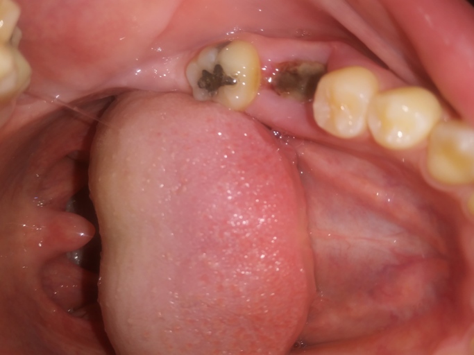 wisdom tooth remol normal healing images